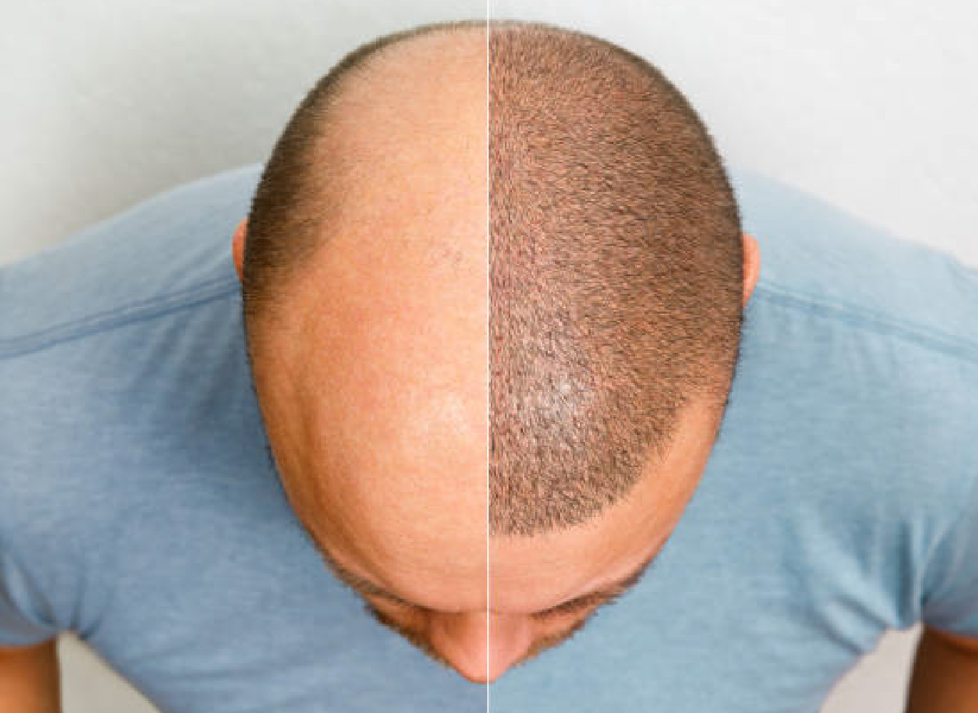 FUE Hair Transplant